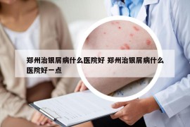 郑州治银屑病什么医院好 郑州治银屑病什么医院好一点