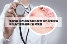 银屑病的血热血燥怎么区分啊 血热型银屑病和血燥型银屑病症状有何区别