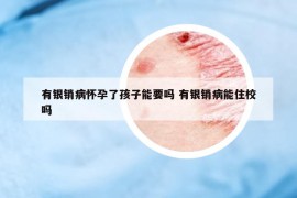 有银销病怀孕了孩子能要吗 有银销病能住校吗