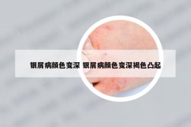 银屑病颜色变深 银屑病颜色变深褐色凸起