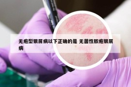 无疱型银屑病以下正确的是 无菌性脓疱银屑病