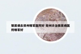 银屑病去郑州哪家医院好 郑州诊治银屑病医院哪家好