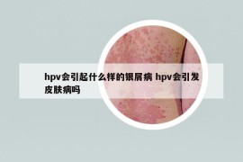 hpv会引起什么样的银屑病 hpv会引发皮肤病吗