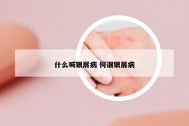 什么喊银屑病 何谓银屑病