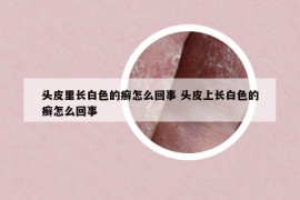 头皮里长白色的癣怎么回事 头皮上长白色的癣怎么回事