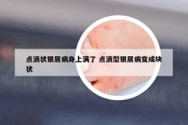 点滴状银屑病身上满了 点滴型银屑病变成块状