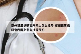 郑州银屑病研究所网上怎么挂号 郑州银屑病研究所网上怎么挂号预约