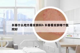 长春什么地方看皮肤科h 长春看皮肤哪个医院好