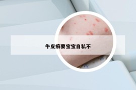 牛皮癣要宝宝自私不