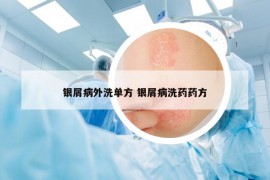 银屑病外洗单方 银屑病洗药药方