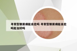 寻常型银屑病能自愈吗 寻常型银屑病能自愈吗能治好吗