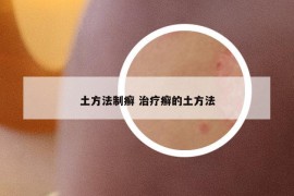 土方法制癣 治疗癣的土方法