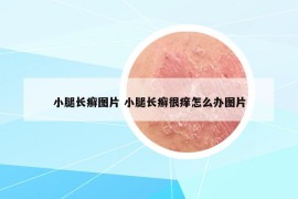 小腿长癣图片 小腿长癣很痒怎么办图片