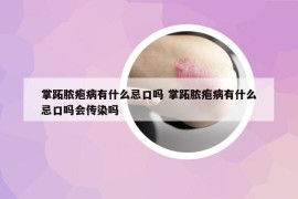 掌跖脓疱病有什么忌口吗 掌跖脓疱病有什么忌口吗会传染吗