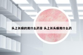 头上长癣的用什么药膏 头上长头癣用什么药