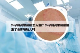 怀孕期间银屑病怎么治疗 怀孕期间银屑病加重了会影响胎儿吗