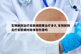 生物制剂治疗皮肤病需要治疗多久 生物制剂治疗皮肤病对身体有伤害吗