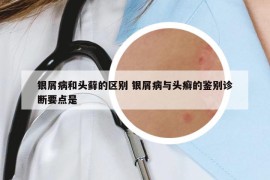 银屑病和头藓的区别 银屑病与头癣的鉴别诊断要点是