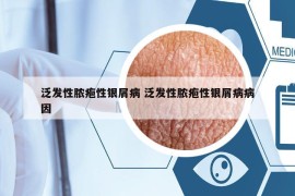 泛发性脓疱性银屑病 泛发性脓疱性银屑病病因