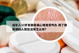 成年人33岁有银屑病心理难受咋办 得了银屑病的人现在活得怎么样?