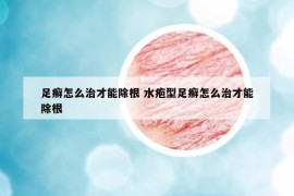 足癣怎么治才能除根 水疱型足癣怎么治才能除根