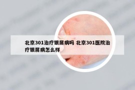 北京301治疗银屑病吗 北京301医院治疗银屑病怎么样