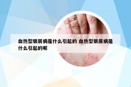 血热型银屑病是什么引起的 血热型银屑病是什么引起的呢