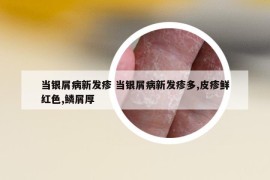 当银屑病新发疹 当银屑病新发疹多,皮疹鲜红色,鳞屑厚