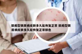 脓疱型银屑病皮肤多久能恢复正常 脓疱型银屑病皮肤多久能恢复正常肤色