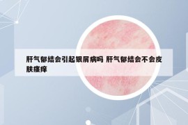 肝气郁结会引起银屑病吗 肝气郁结会不会皮肤瘙痒