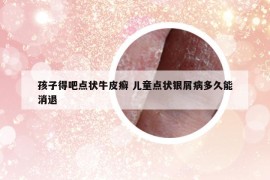 孩子得吧点状牛皮癣 儿童点状银屑病多久能消退