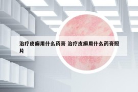 治疗皮癣用什么药膏 治疗皮癣用什么药膏照片