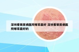 深圳看银屑病医院哪家最好 深圳看银屑病医院哪家最好的