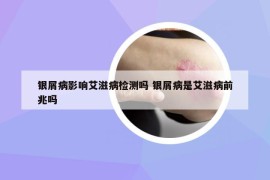 银屑病影响艾滋病检测吗 银屑病是艾滋病前兆吗