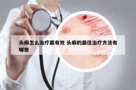 头癣怎么治疗最有效 头癣的最佳治疗方法有哪些