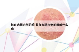 长在大腿内侧的癣 长在大腿内侧的癣叫什么癣