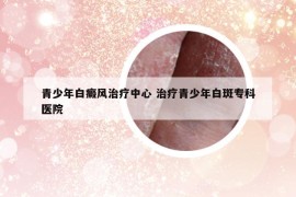 青少年白癜风治疗中心 治疗青少年白斑专科医院