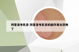 阿昔洛韦乳膏 阿昔洛韦乳膏的副作用太恐怖了