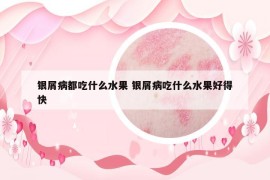 银屑病都吃什么水果 银屑病吃什么水果好得快