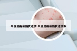 牛皮皮癣会隔代遗传 牛皮皮癣会隔代遗传嘛