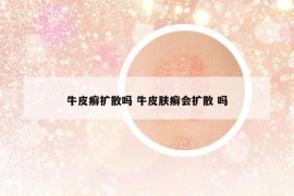 牛皮癣扩散吗 牛皮肤癣会扩散 吗