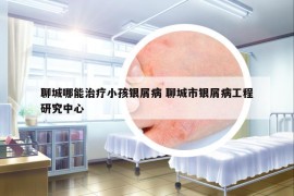 聊城哪能治疗小孩银屑病 聊城市银屑病工程研究中心