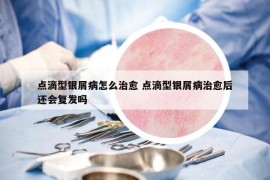 点滴型银屑病怎么治愈 点滴型银屑病治愈后还会复发吗