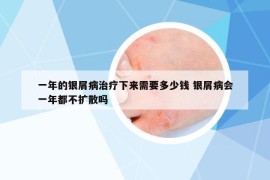 一年的银屑病治疗下来需要多少钱 银屑病会一年都不扩散吗