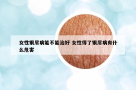 女性银屑病能不能治好 女性得了银屑病有什么危害