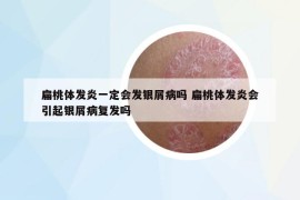 扁桃体发炎一定会发银屑病吗 扁桃体发炎会引起银屑病复发吗