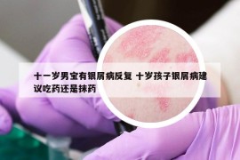 十一岁男宝有银屑病反复 十岁孩子银屑病建议吃药还是抹药