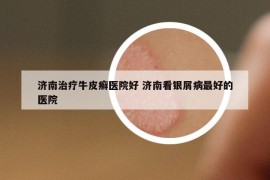 济南治疗牛皮癣医院好 济南看银屑病最好的医院