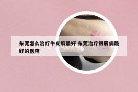 东莞怎么治疗牛皮癣最好 东莞治疗银屑病最好的医院