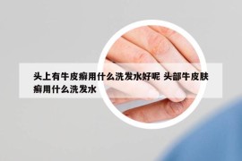 头上有牛皮癣用什么洗发水好呢 头部牛皮肤癣用什么洗发水